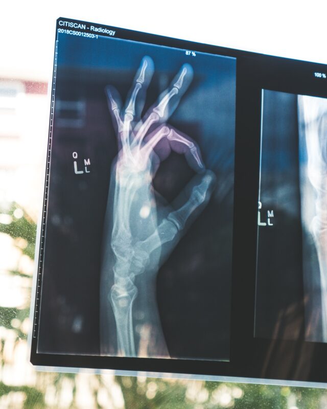 X-Ray of Hand